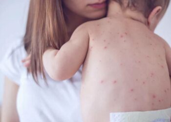 Даже привитые в зоне риска? В Казахстане продолжает расти заболеваемость корью